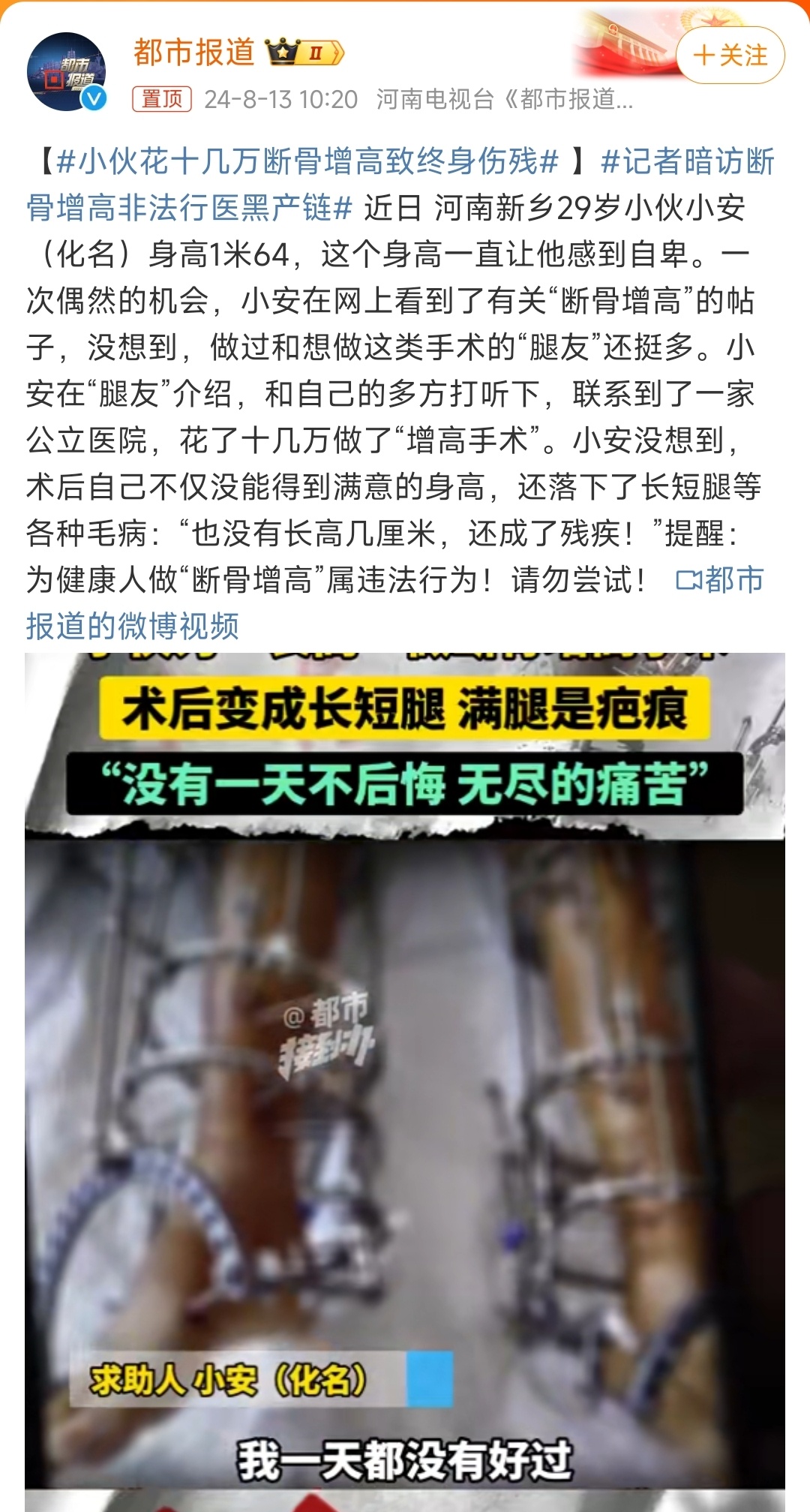 最新斷骨增高,最新斷骨增高技術(shù)，重塑身高的希望之光